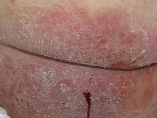 Figuur 1: maceratie van de huid als gevolg van vocht